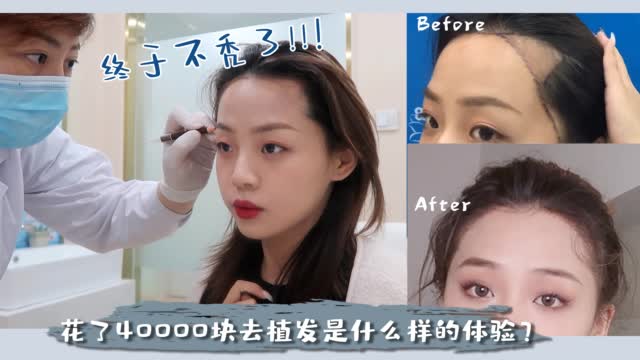 ◆袖袖◆跟大脑门说拜拜超细致植发分享